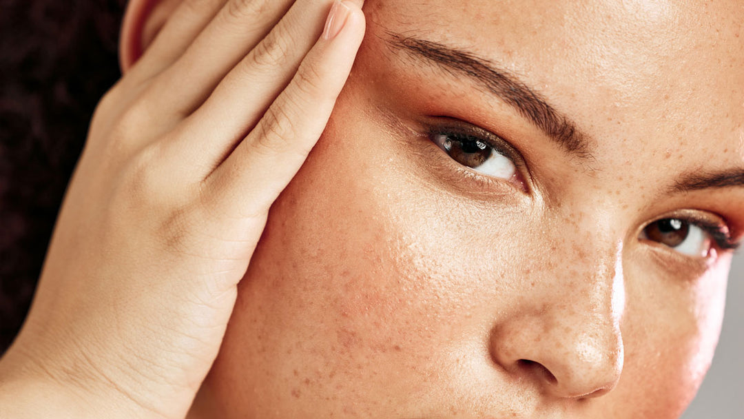 What is Blackheads, whiteheads and how to get rid of them